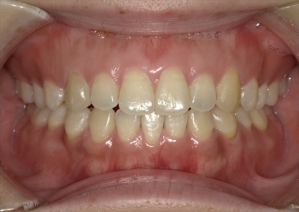 症例7治療後正面
